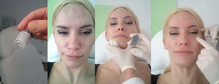 Test Botox Und Hyaluronsaure Behandlung Mein Erfahrungsbericht Ist Das Sinnvoll Im Anti Aging Bereich Die Beautybloggerin