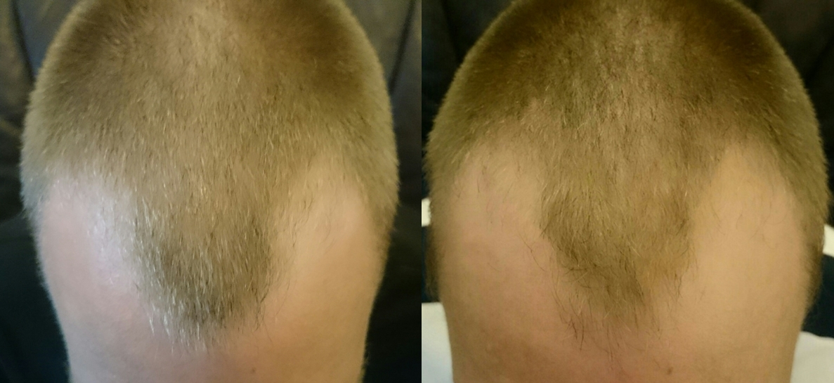 Geheimratsecken regain Hair transplant