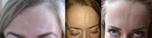 Hier ist gut zu erkennen, wie sich die Falten innerhalb von vier Wochen nach der Botox-Behandlung geglättet haben