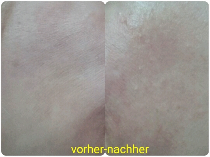 Wange der Testerin mit trockener Haut und Trockenheitsfältchen- vorher und nach 1 Woche