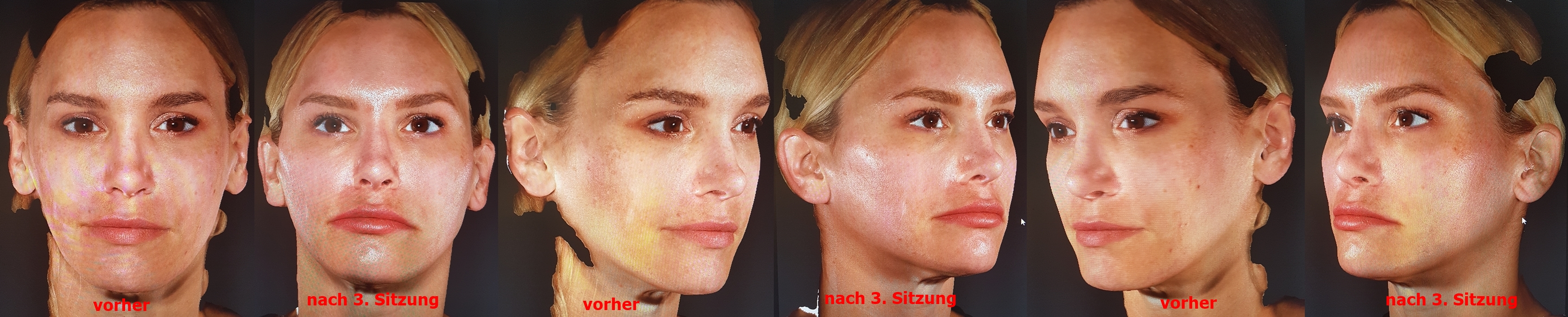 Serie Sprechstunde Bei Dr Hoffmann Mittelgesicht Volumisierung Nach Dr De Maio Die Beautybloggerin