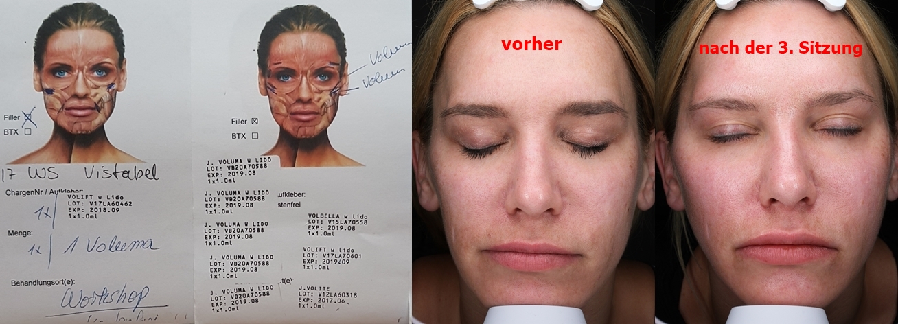 Serie Sprechstunde Bei Dr Hoffmann Mittelgesicht Volumisierung Nach Dr De Maio Die Beautybloggerin