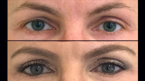 Test: Erfahrungsbericht Oberlidstraffung | Lidkorrektur health2beauty | Dr. Eva Kusch | Essen/NRW | Blepharoplastik